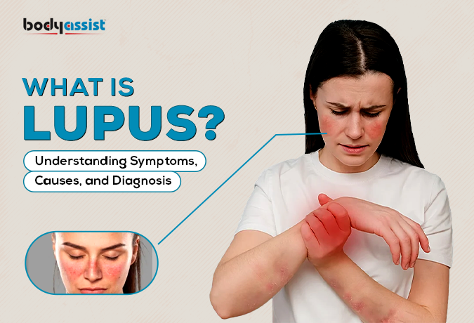 What is Lupus? Understanding Symptoms, Causes, and Diagnosis